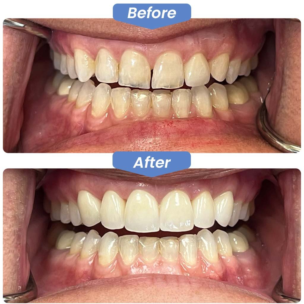 Front-Teeth-Crown-Before-After.jpg