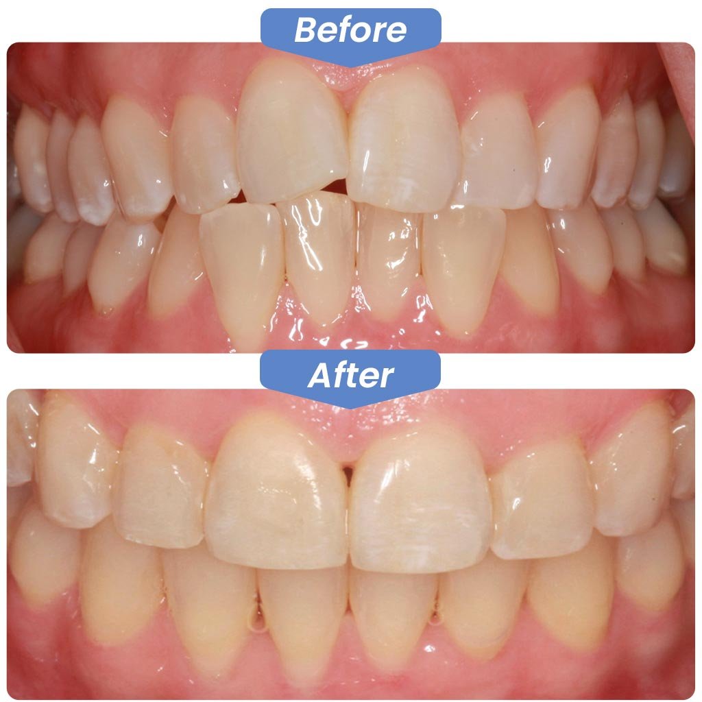 Gallery-Before-After-Kirkland-Dental.jpg